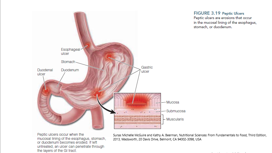 Ce este si cum se manifesta ulcerul