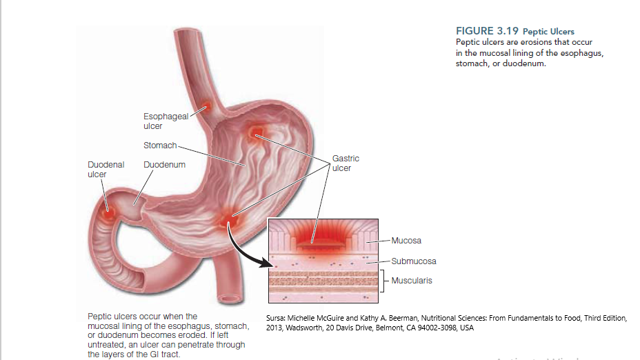 Caracteristici de pierdere în greutate în gastrită și ulcer gastric